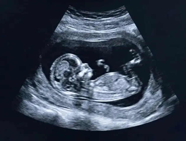 Ultrasound this one